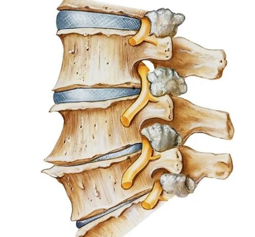 Squeezing of the nerve in the spine