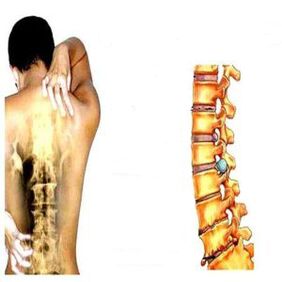 Phases of osteocondrosis