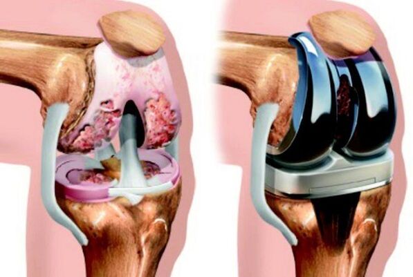 Before and after endoprotetics of the knee joint with arthrosis
