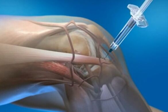 Intra -articular injections to the arthosis of the knee joint